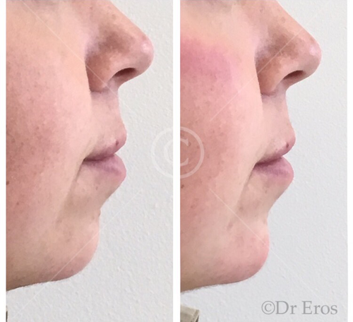 Before and after chin filler