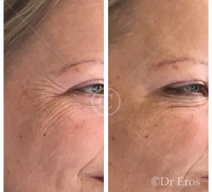 Before and after botox crows feet eye wrinkles