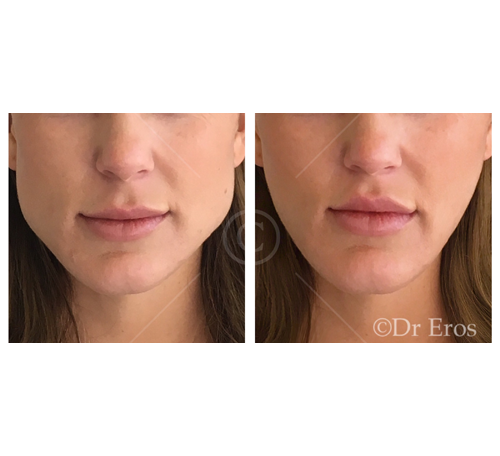 Before and after botox for jaw slimming reduction