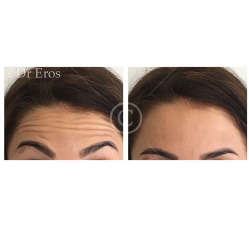 Before and after botox forehead lines Corrugator lines