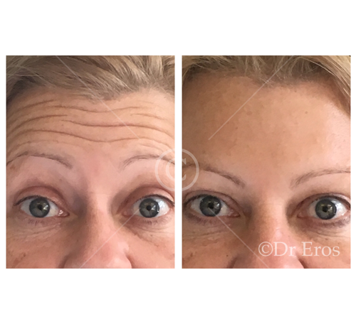 Before and after botox forehead lines