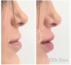 Before and after lip fillers Melbourne Botox
