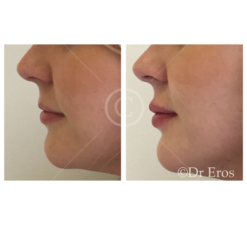 Before and after lip fillers Melbourne Botox Dr Eros