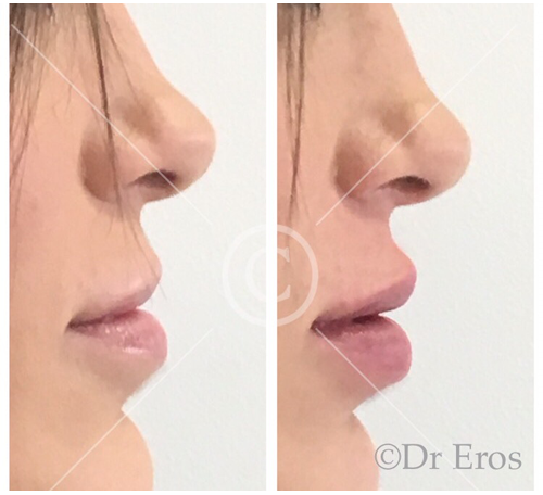 Before and after lip filler