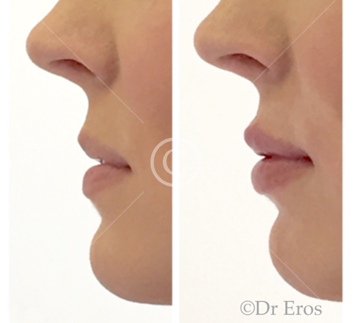 Before and after lip filler