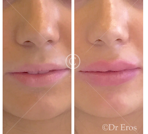 Before and after lip fillers Melbourne