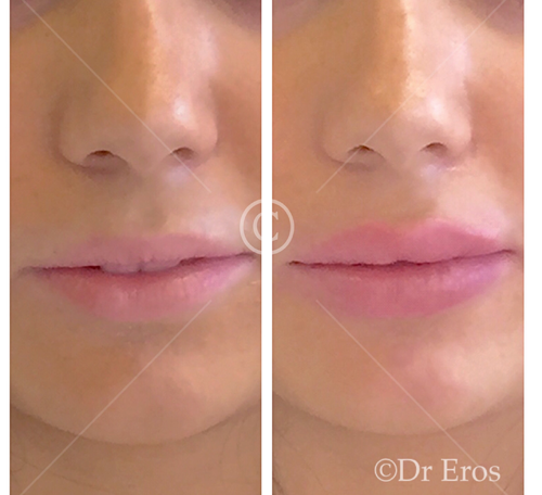 Before and after lip filler