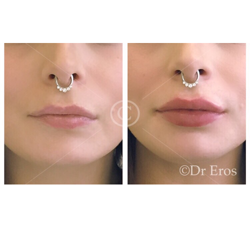 Before and after lip filler