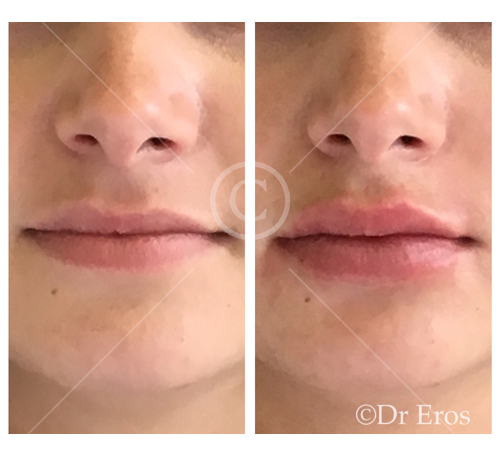 Before and after lip fillers anti-wrinkle