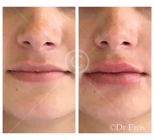 Before and after lip filler