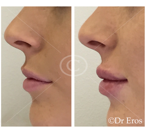 Before and after lip fillers botox freeze