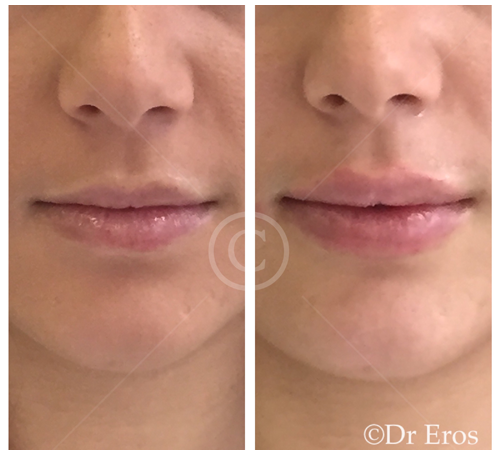Before and after lip fillers botox natural look