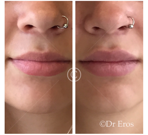 Before and after lip fillers cosmetic doctor eros