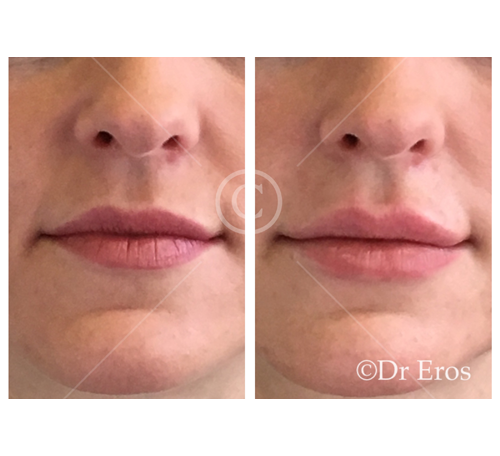 Before and after lip filler