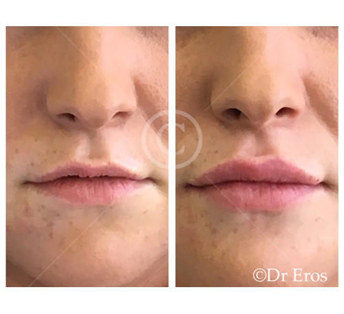 Before and after lip fillers cosmetic lips