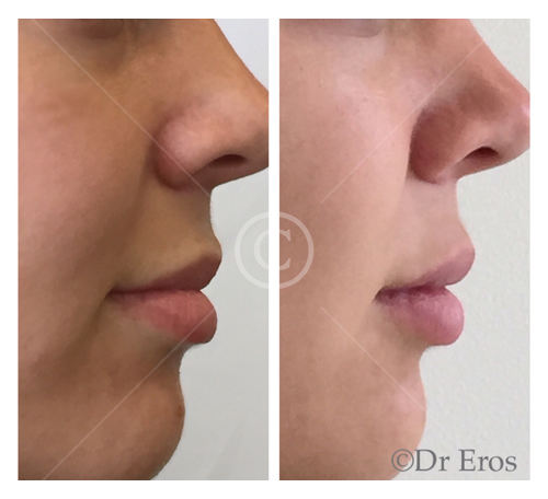 Before and after lip filler