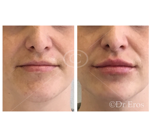 Before and after lip filler