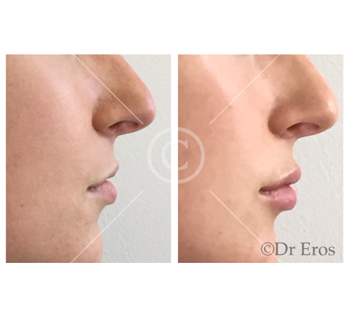 Before and after lip fillers melbourne anti-wrinkle