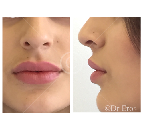 Dr Eros Lips Fillers