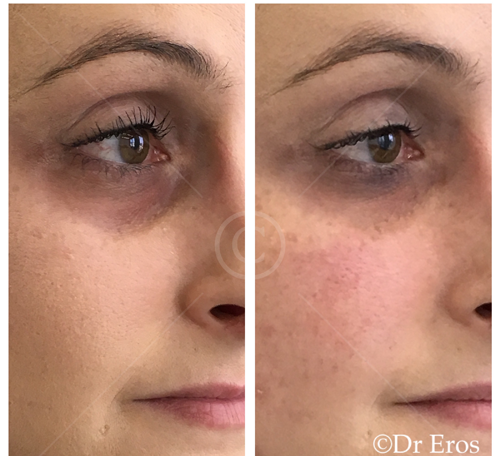 before and after tear trough filler