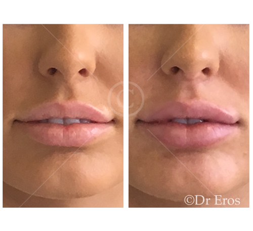 Before and after lip filler