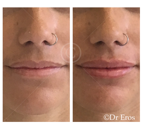 before and after lip filler