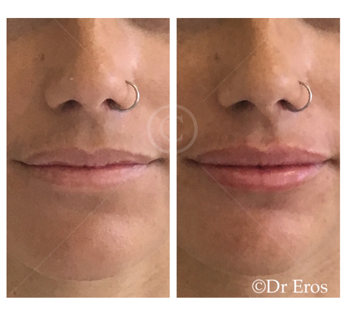 Before and after lip filler