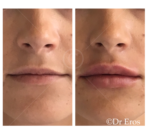 Before and after lip filler