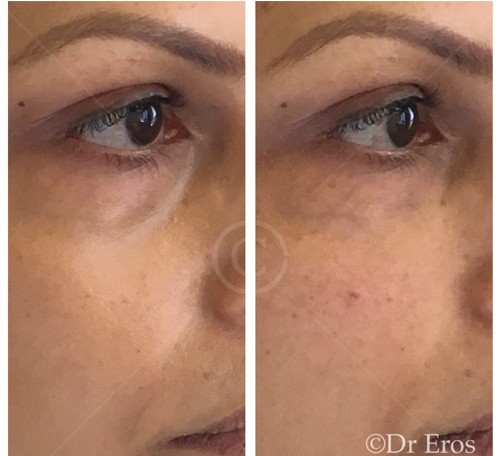 Before and after tear trough