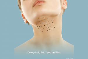 Kybella Belkyra injection