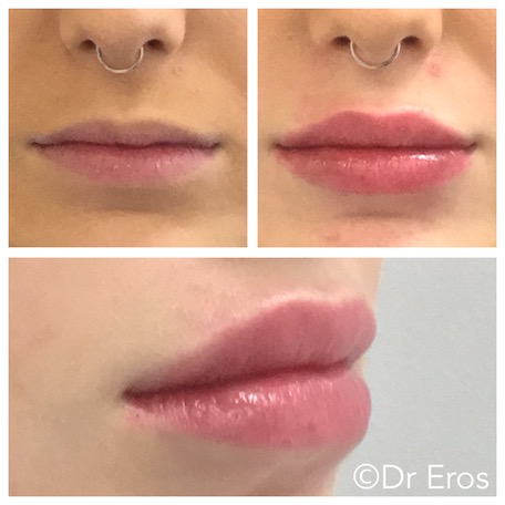 Lips Before and After